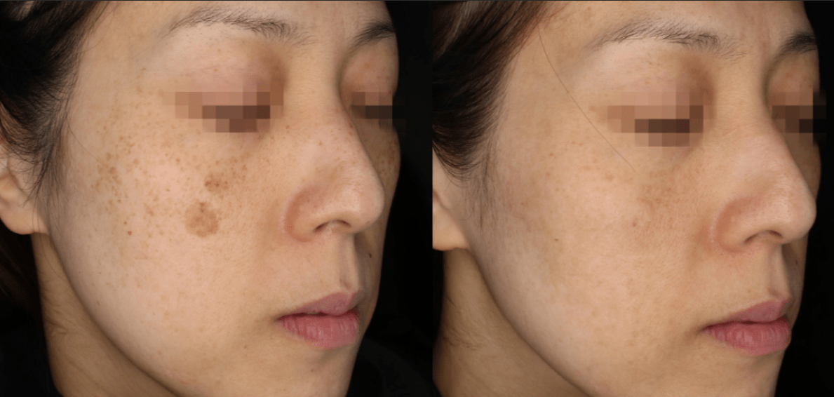 PicoSure-PRO-gallery-1