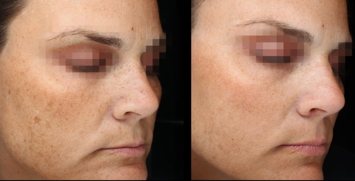 PicoSure-PRO-gallery-2