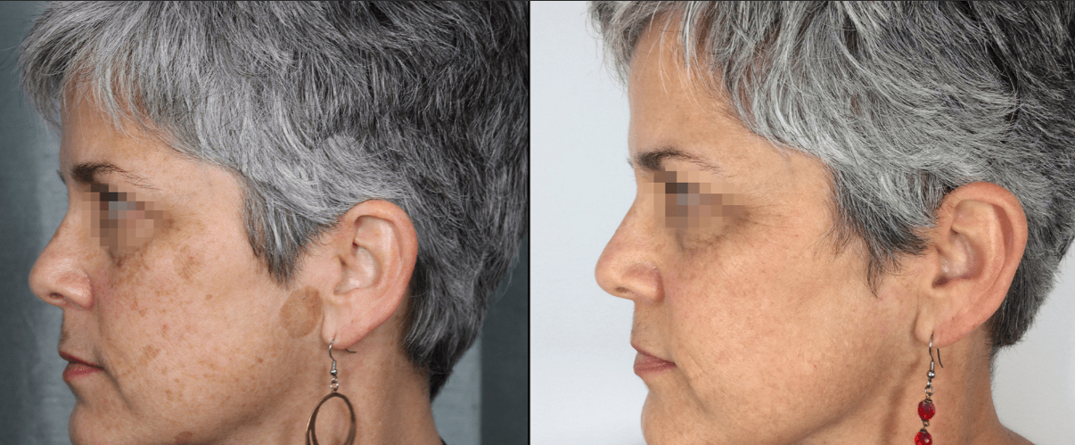 PicoSure-PRO-gallery-3
