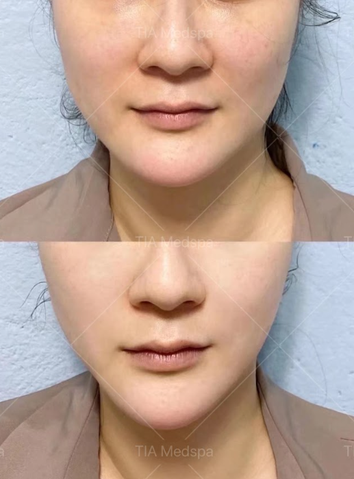 Ultherapy-gallery-1