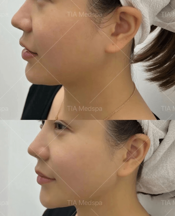 Ultherapy-gallery-2