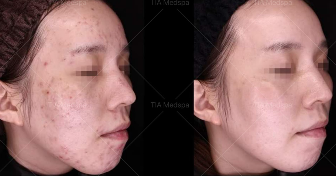 Ultherapy-gallery-3