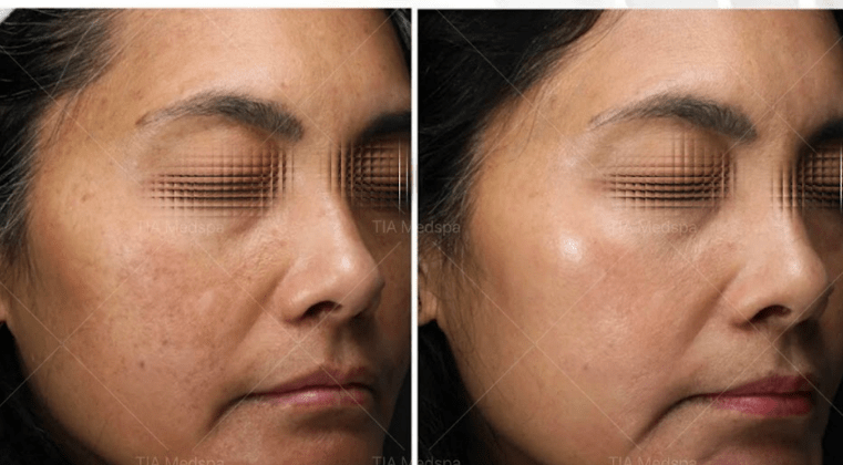Ultherapy-gallery-4