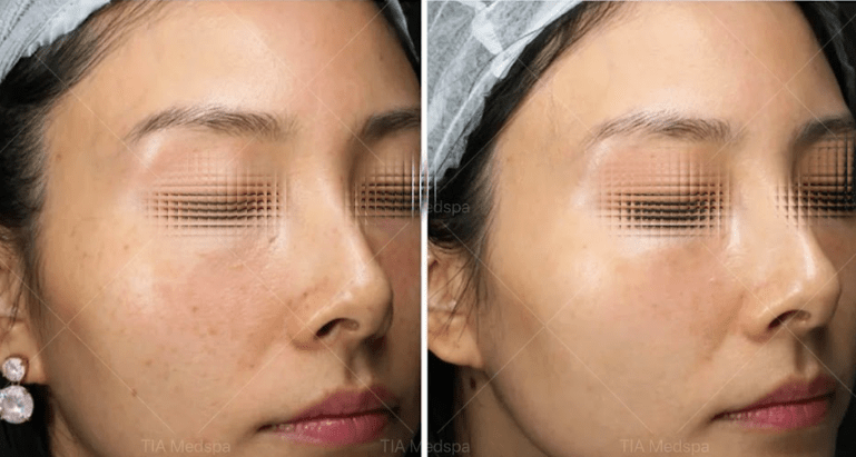 Ultherapy-gallery-5